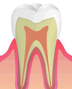 C0　初期虫歯