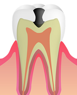 C2　痛みが伴い、虫歯が進行している状態